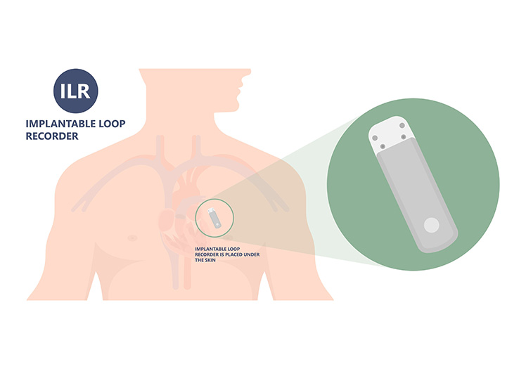 The image shows an illustration of a human torso with internal organs, including the heart and lungs, highlighted by a magnifying glass. A small electronic device labeled  Implantable Loop Recorder  is depicted as being implanted in the chest area next to the heart.